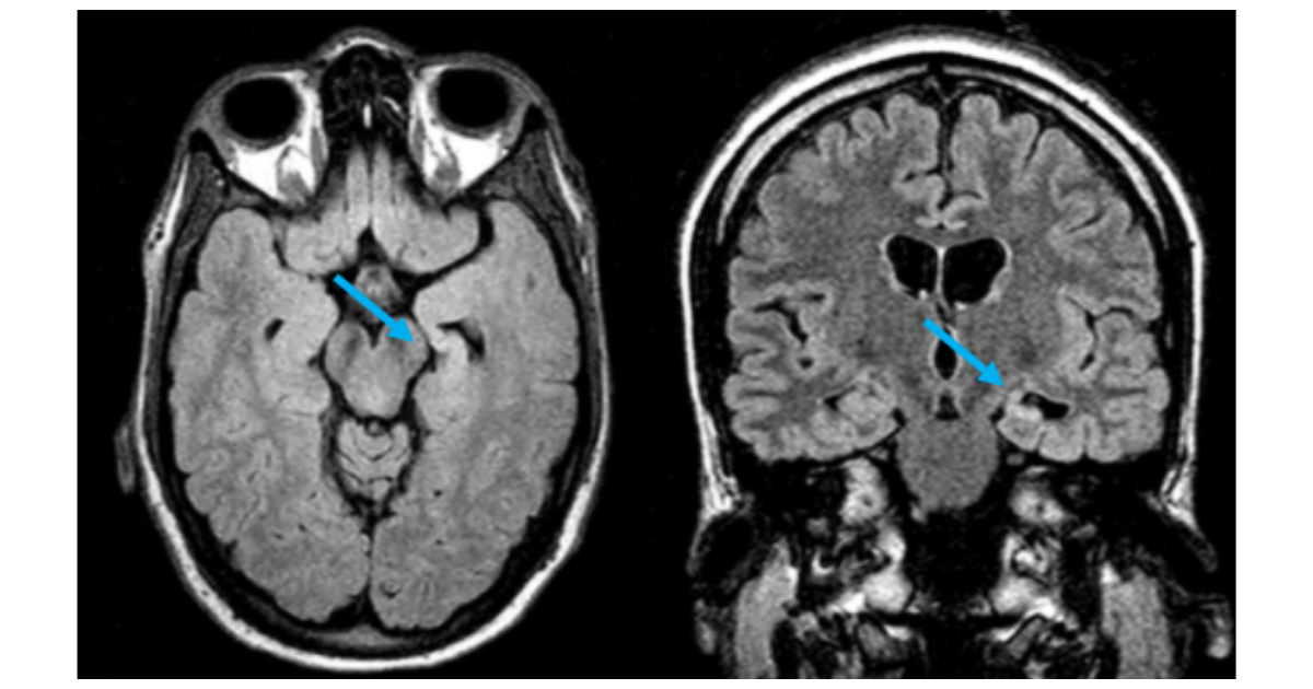 MRI shows left mesial temporal sclerosis