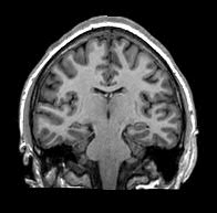 medial temporal lobe epilepsy