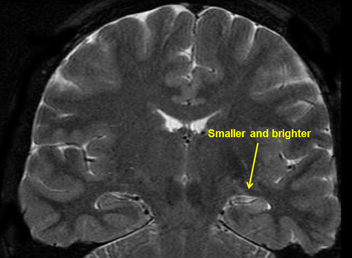 frontal lobe epilepsy symptoms